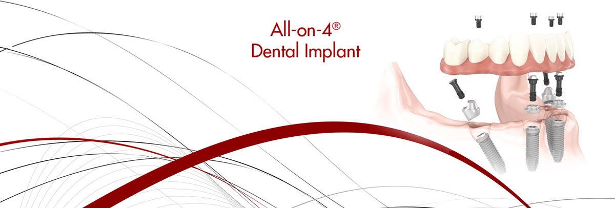 Mason All-on-4 Dental Implants