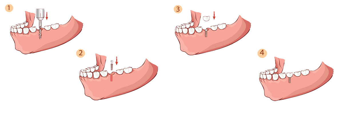 Mason The Dental Implant Procedure