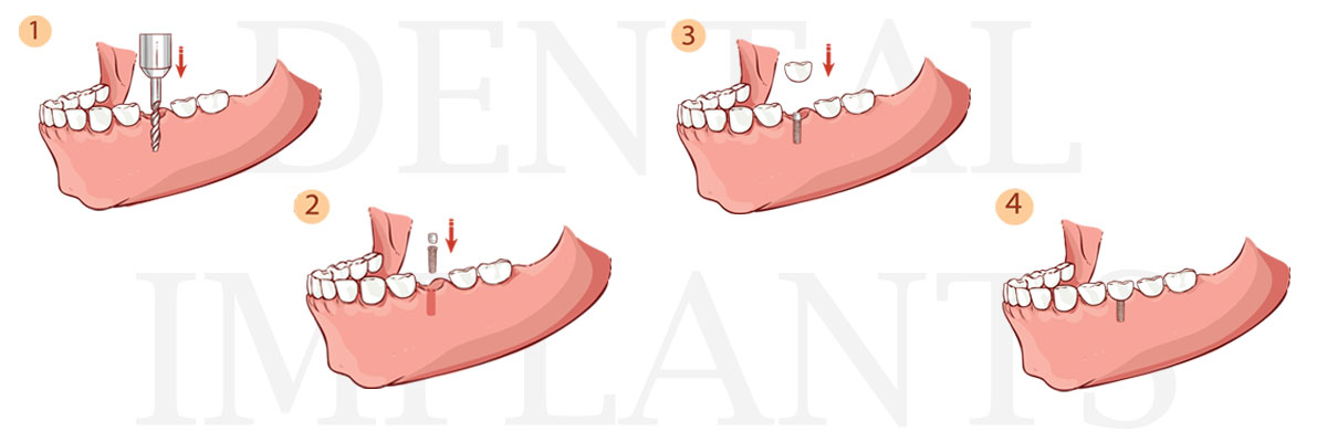 Mason The Difference Between Dental Implants and Mini Dental Implants