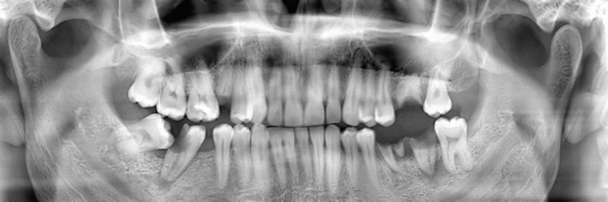 Mason Options for Replacing Missing Teeth